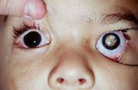 Retinoblastoma in the left eye 