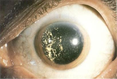 DYSTROPHIC CHANGES OF THE VITREOUS Optometry Today